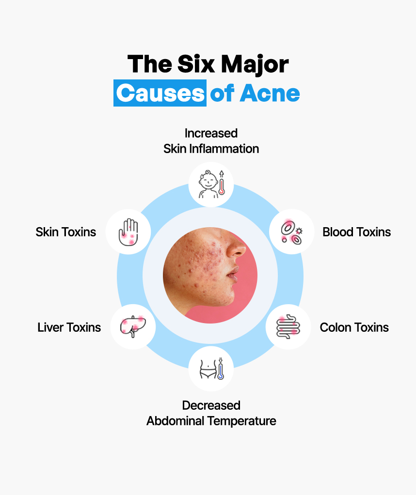 The Six Major Causes of Acne