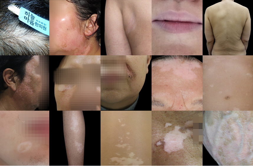 다양한 부위에 발병된 백반증 사례들