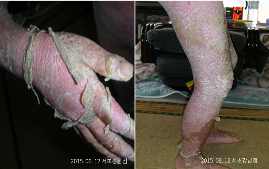 일본에서 온 온몸이 건선으로 뒤덮힌 환자