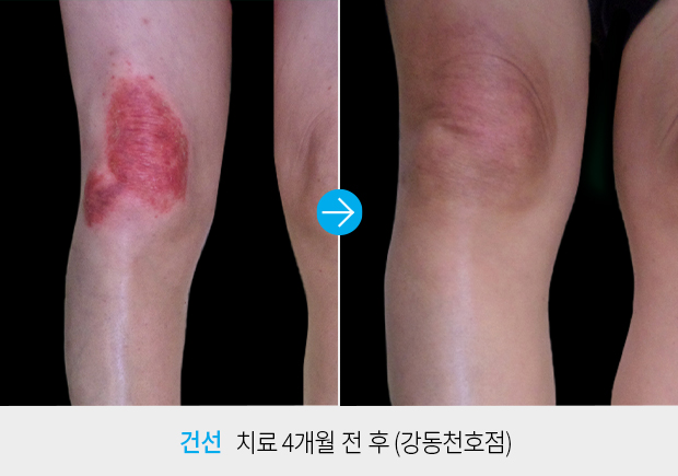 건선 치료4개월 전/후(강동천호점)