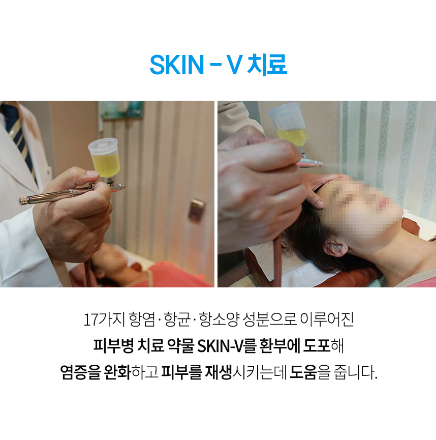 피부 치료 약물 SKIN-V 치료