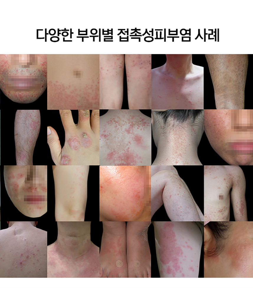 다양한 부위별 접촉성피부염 사례.