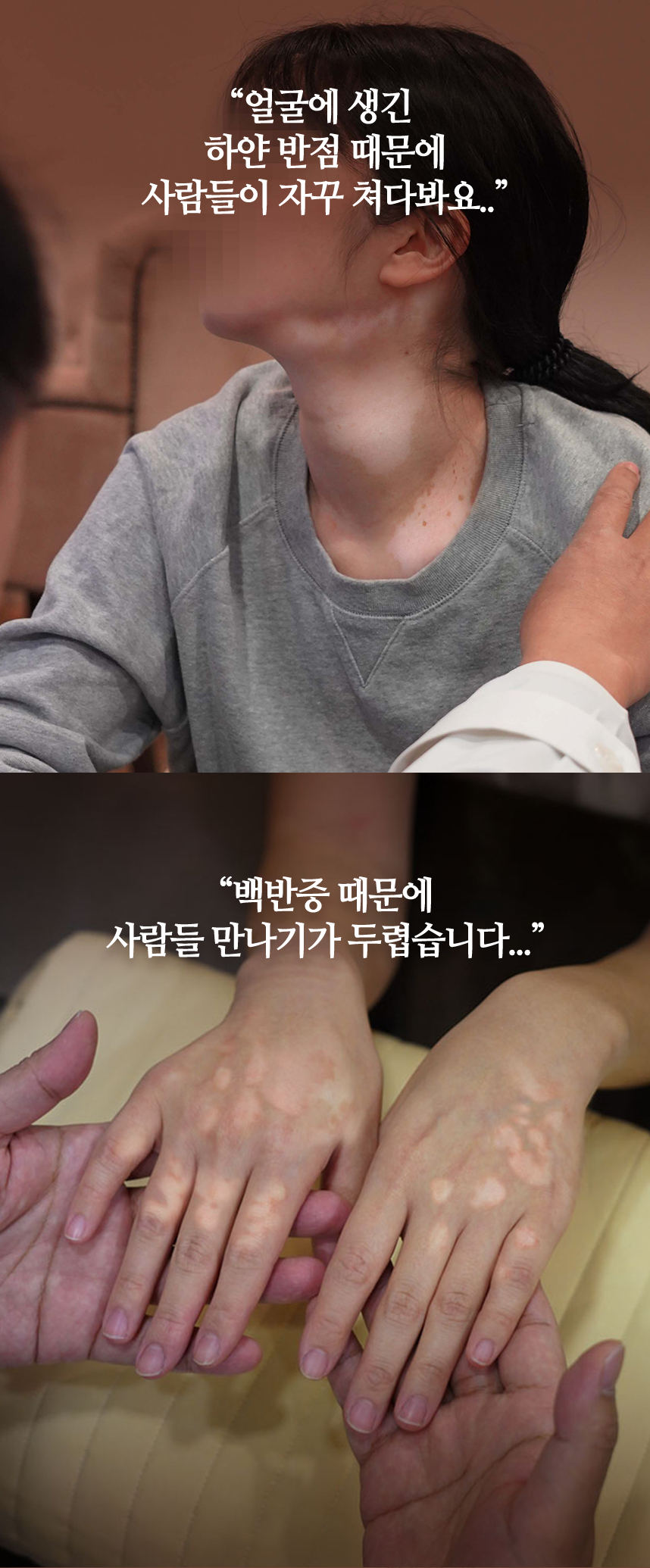 얼굴에 생긴 하얀 반점 때문에 사람들이 자꾸 쳐다봐요.