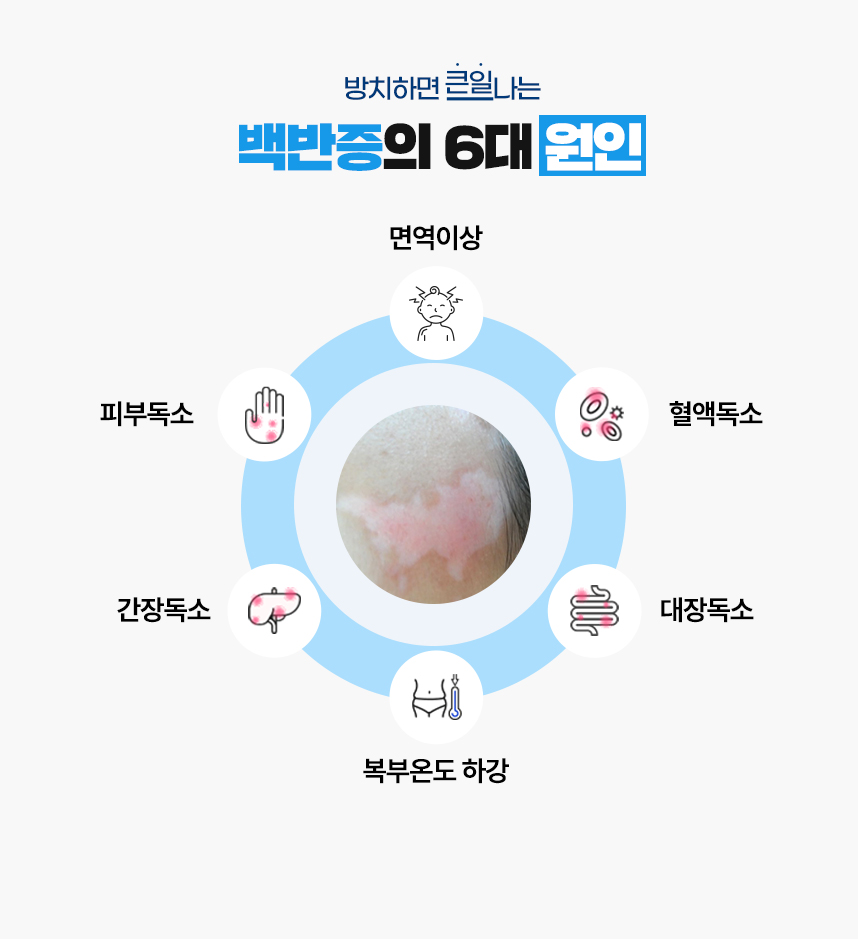 또한 백반증 증상이 있는 피부 온도는 높게 상승되어 있고 복부 온도는 낮게 하강되어 있는 병리적인 특성이 있어 이 6가지를 백반증이 발병하는 6대 원인으로 보고 있습니다.