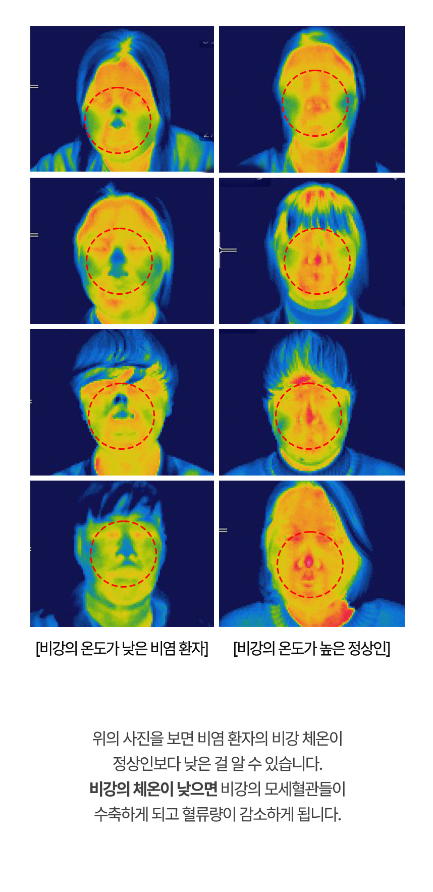 아래는 열화상카메라로 촬영한 사진으로 비염 환자의 비강 체온이 정상인보다 낮은 걸 알 수 있습니다.
