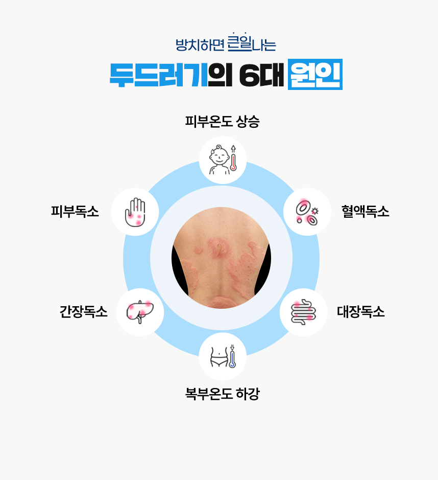 또한 두드러기 증상이 있는 피부 온도는 높게 상승되어 있고 복부 온도는 낮게 하강되어 있는 병리적인 특성이 있어 이 6가지를 두드러기가 발병하는 6대 원인으로 보고 있습니다.