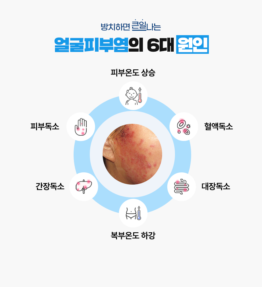 또한 얼굴피부염 증상이 있는 피부 온도는 높게 상승되어 있고 복부 온도는 낮게 하강되어 있는 병리적인 특성이 있어 이 6가지를 얼굴피부염이 발병하는 6대 원인으로 보고 있습니다.