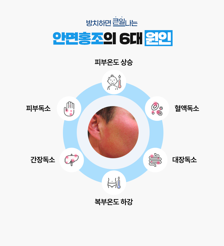 또한 안면홍조 증상이 있는 피부 온도는 높게 상승되어 있고 복부 온도는 낮게 하강되어 있는 병리적인 특성이 있어 이 6가지를 안면홍조가 발병하는 6대 원인으로 보고 있습니다.