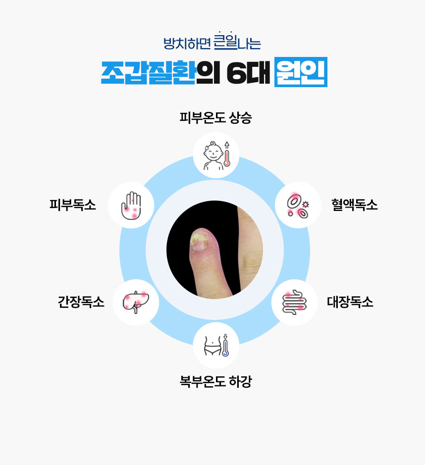 또한 조갑질환 증상이 있는 피부 온도는 높게 상승되어 있고 복부 온도는 낮게 하강되어 있는 병리적인 특성이 있어 이 6가지를 조갑질환이 발병하는 6대 원인으로 보고 있습니다.