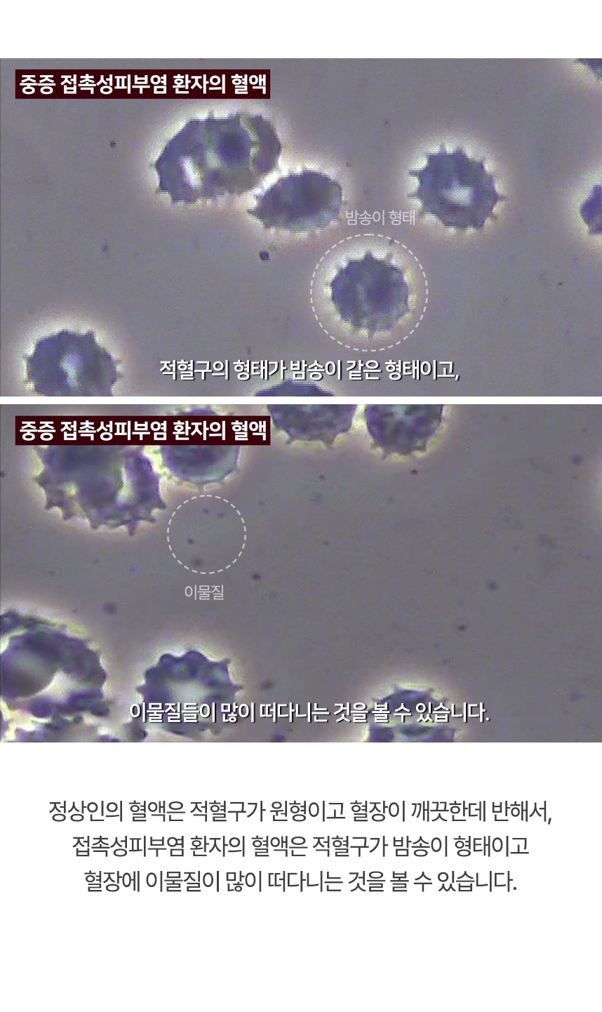 정상인의 혈액은 적혈구가 원형이고 혈장이 깨끗한데 반해서, 접촉성피부염 환자의 혈액은 적혈구가 밤송이 형태이고 혈장에 이물질이 많이 떠다니는 것을 볼 수 있습니다.