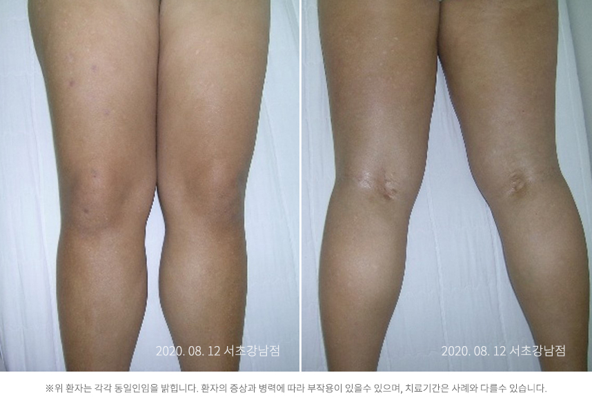 하늘마음한의원 청열 해독후 치료된 모습