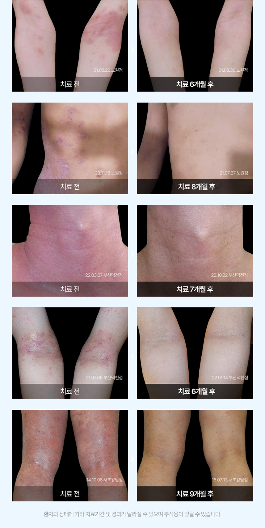 아토피 치료 전후 사례