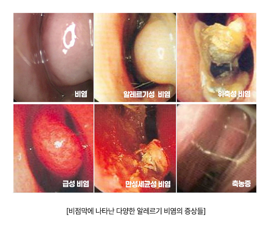 비염, 알레르기성 비염, 위축성 비염, 급성 비염, 만성세균성 비염, 축농증