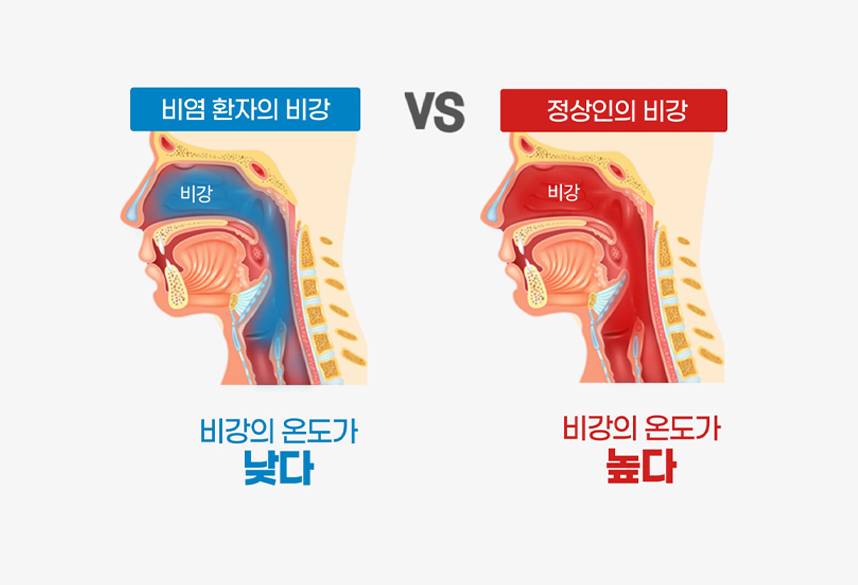 비염환자 : 비강의 온도가 낮다, 정상인 : 비강의 온도가 높다