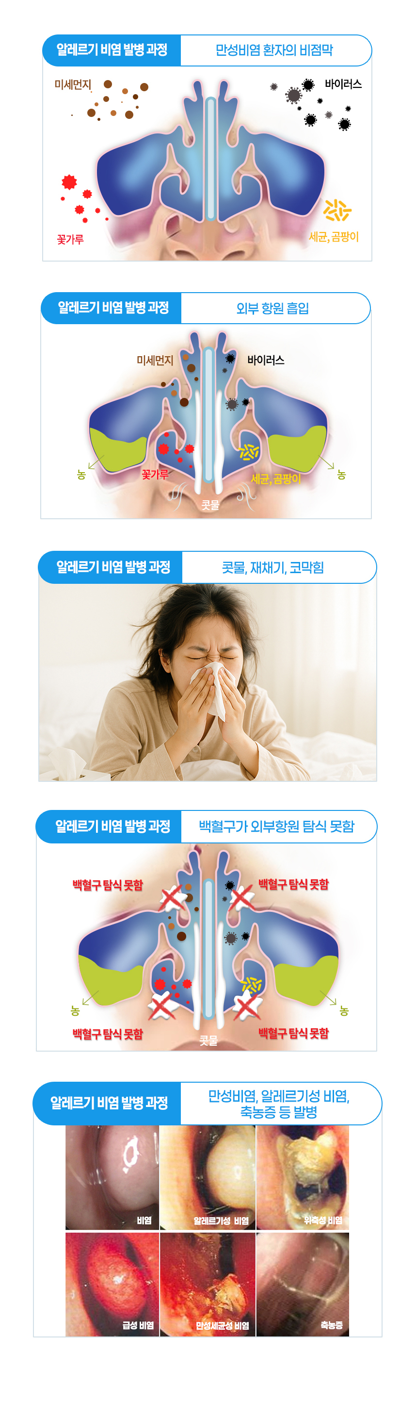 비염 발병 과정 : 외부 항원 흡입 - 콧물, 재채기, 코막힘 - 백혈구가 외부항원 탐식 못함