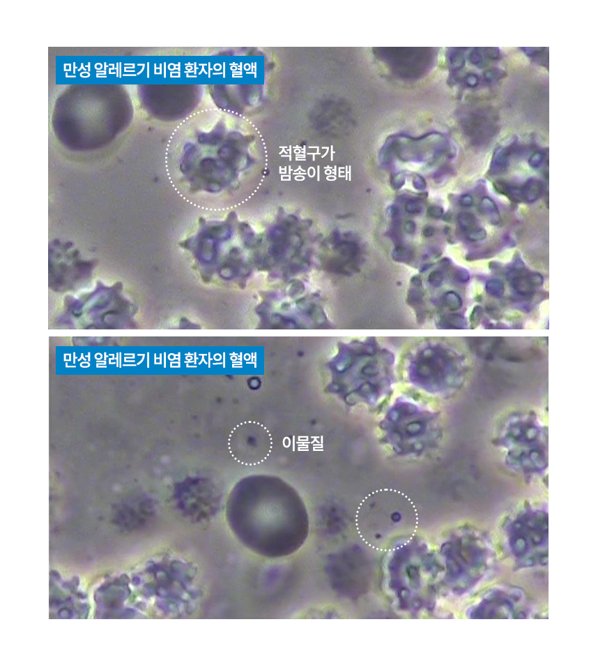 만성 비염 환자의 혈액 : 적혈구의 형태가 밤송이 같은 형태이고, 이물질들이 많이 떠다니는 것을 볼 수 있습니다.