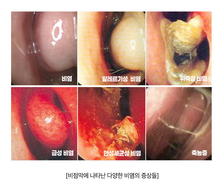 비염, 알레르기성 비염, 위축성 비염, 급성 비염, 만성세균성 비염, 축농증