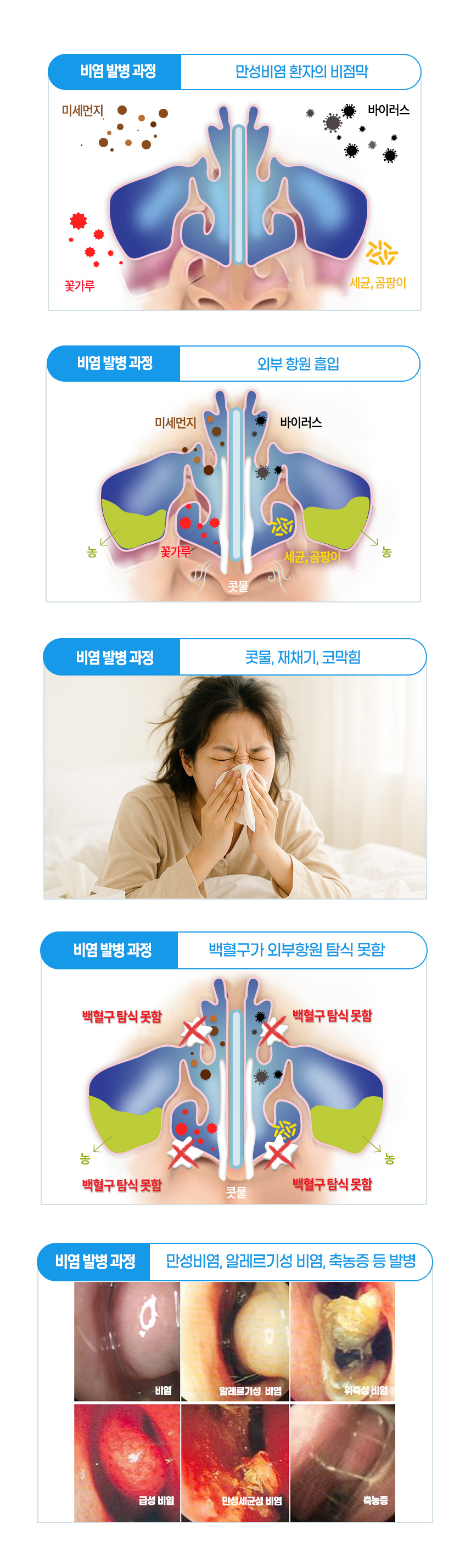 비염 발병 과정 : 외부 항원 흡입 - 콧물, 재채기, 코막힘 - 백혈구가 외부항원 탐식 못함