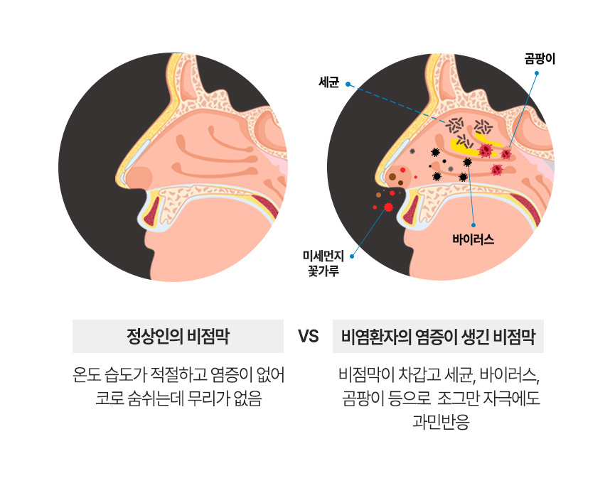 정상인의 비점막 : 온도 습도가 적절하고 염증이 없어 코로 숨쉬는데 무리가 없음. 비염환자의 염증이 생긴 비점막 : 비점막이 차갑고 세균, 바이러스, 곰팡이 등으로 조그만 자극에도 과민반응