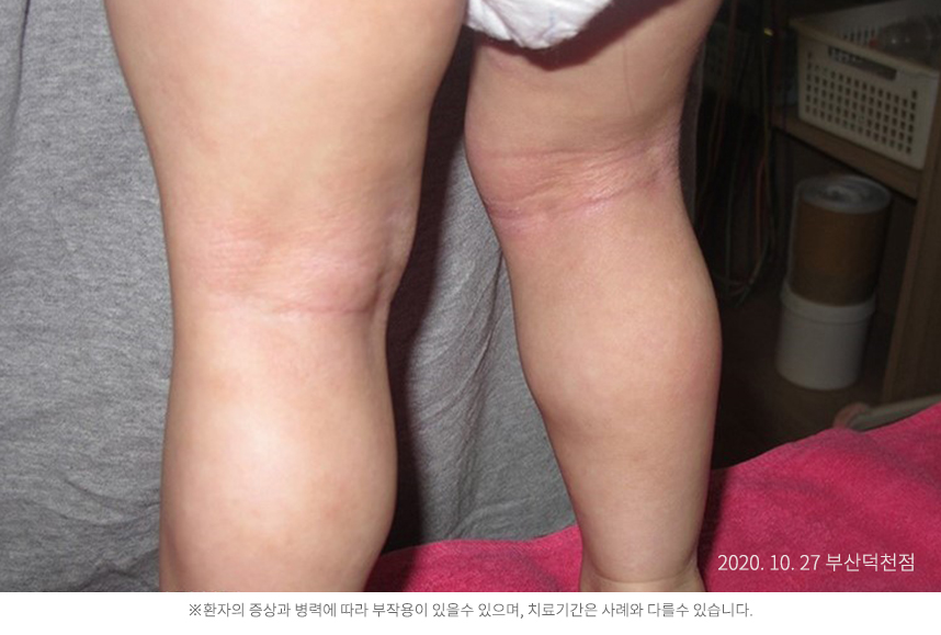 하늘마음한의원 청열 해독후 치료된 모습