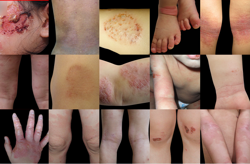 다양한 부위에 발병된 소아 아토피 사례들