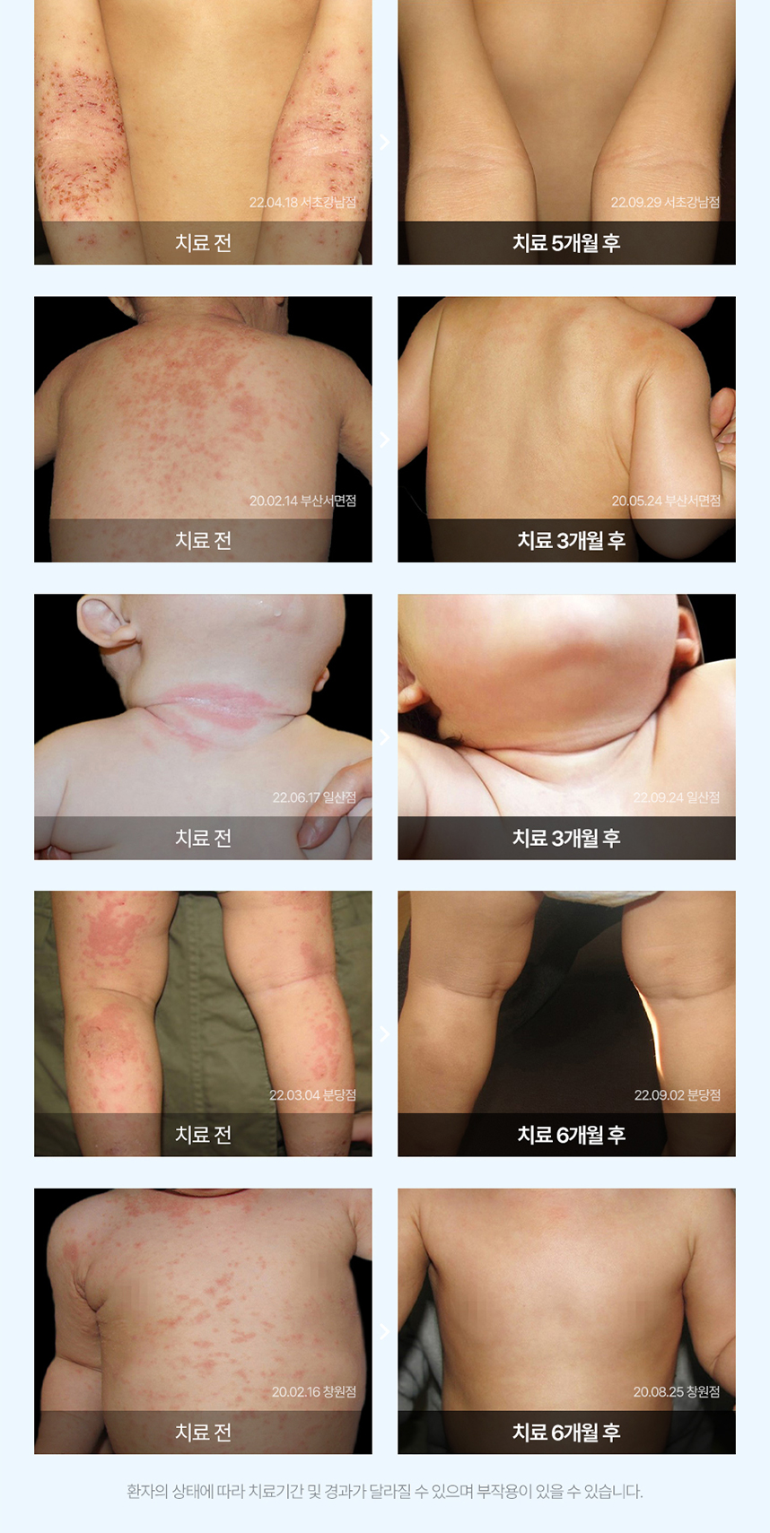 소아 아토피 치료 전후 사례