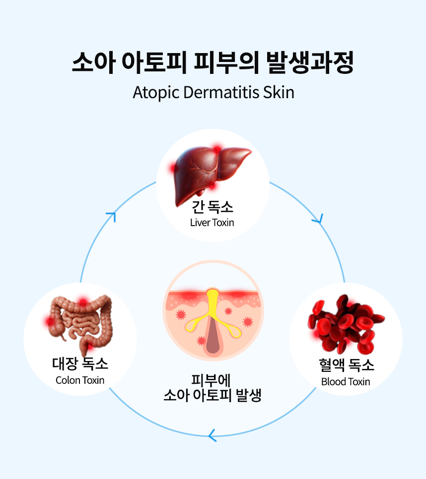 소아 아토피 피부의 발생과정