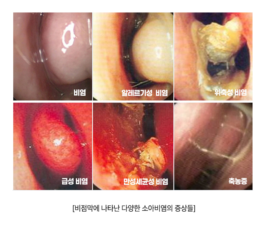 비염, 알레르기성 비염, 위축성 비염, 급성 비염, 만성세균성 비염, 축농증