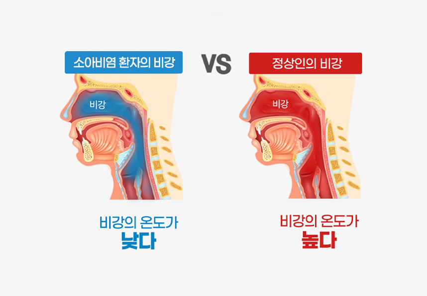 비염환자 : 비강의 온도가 낮다, 정상인 : 비강의 온도가 높다
