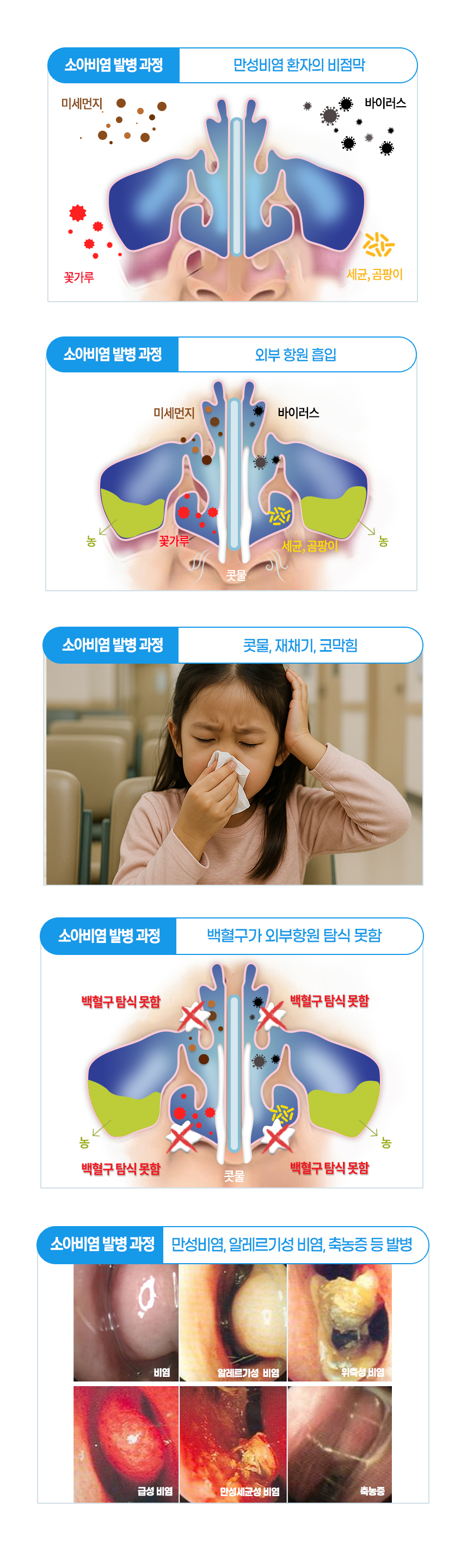 비염 발병 과정 : 외부 항원 흡입 - 콧물, 재채기, 코막힘 - 백혈구가 외부항원 탐식 못함