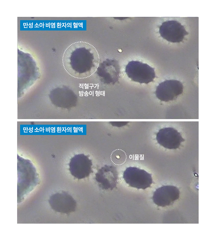 만성 비염 환자의 혈액 : 적혈구의 형태가 밤송이 같은 형태이고, 이물질들이 많이 떠다니는 것을 볼 수 있습니다.