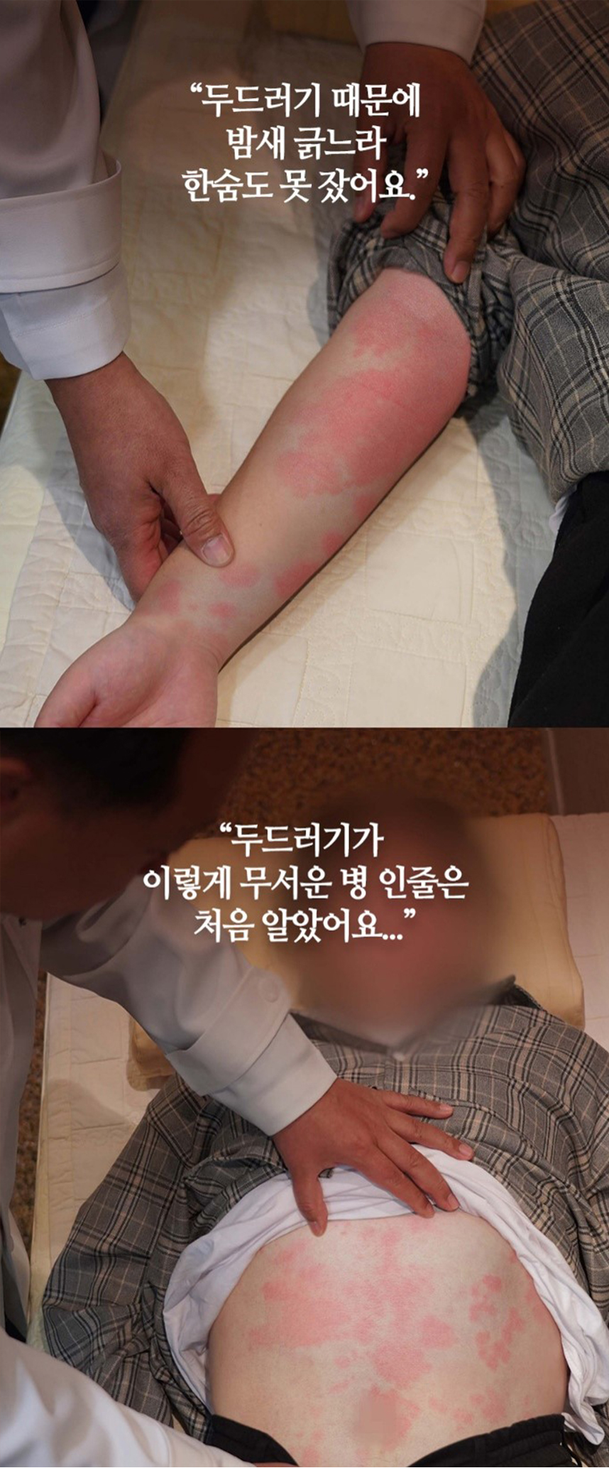 두드러기가 이렇게 무서운 병 인줄은 처음 알았어요.