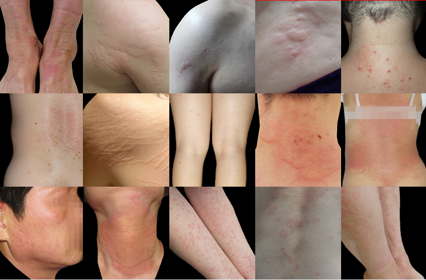 다양한 부위에 발병된 두드러기 사례들