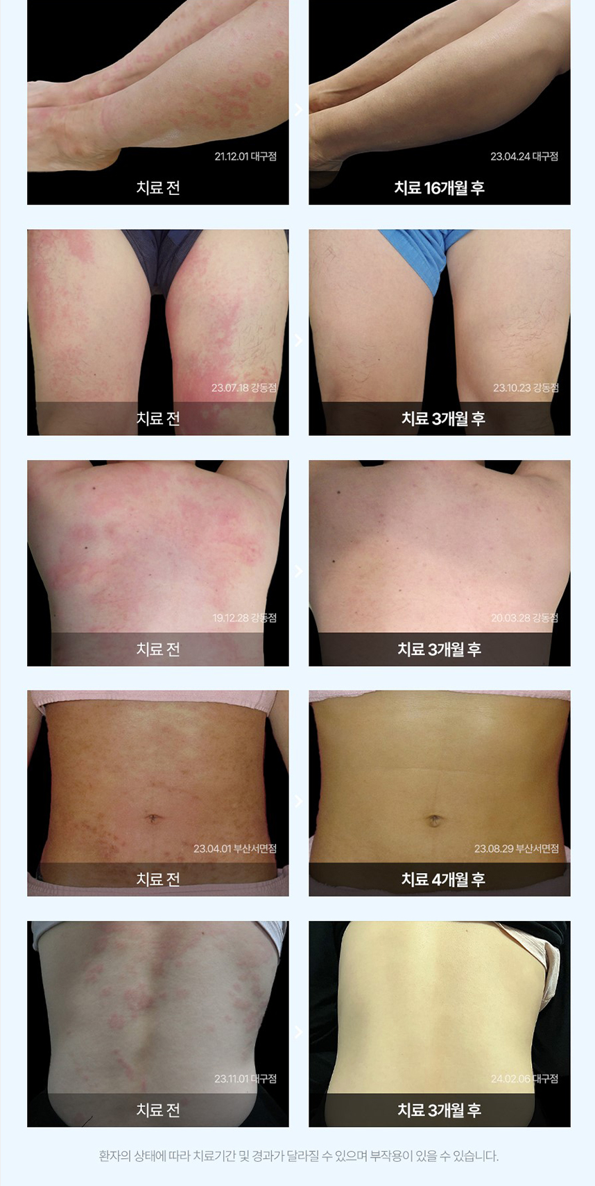 두드러기 치료 전후 사례