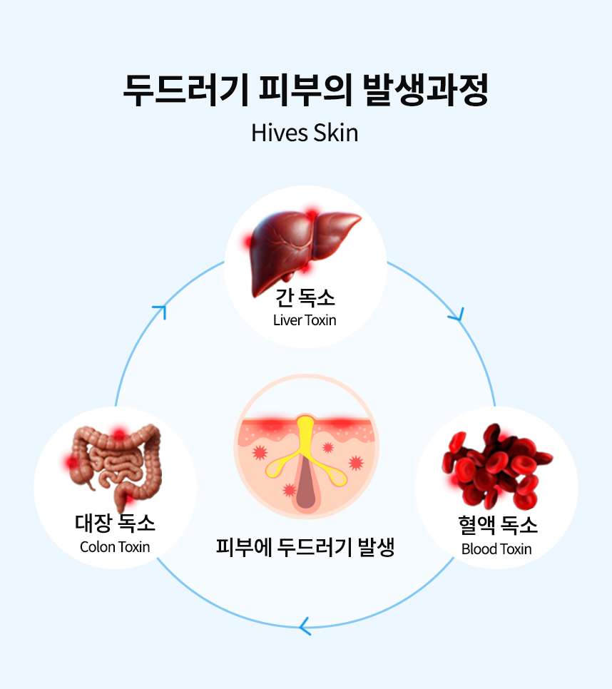 두드러기 피부의 발생과정