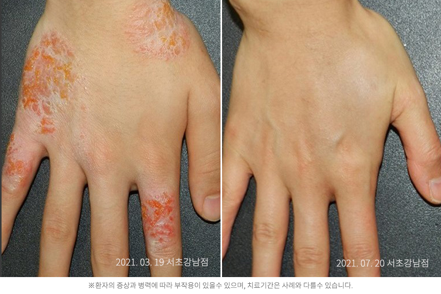 한포진 병력8개월 10대 남자