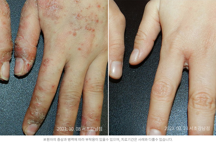 한포진 병력 8개월 8세 남아