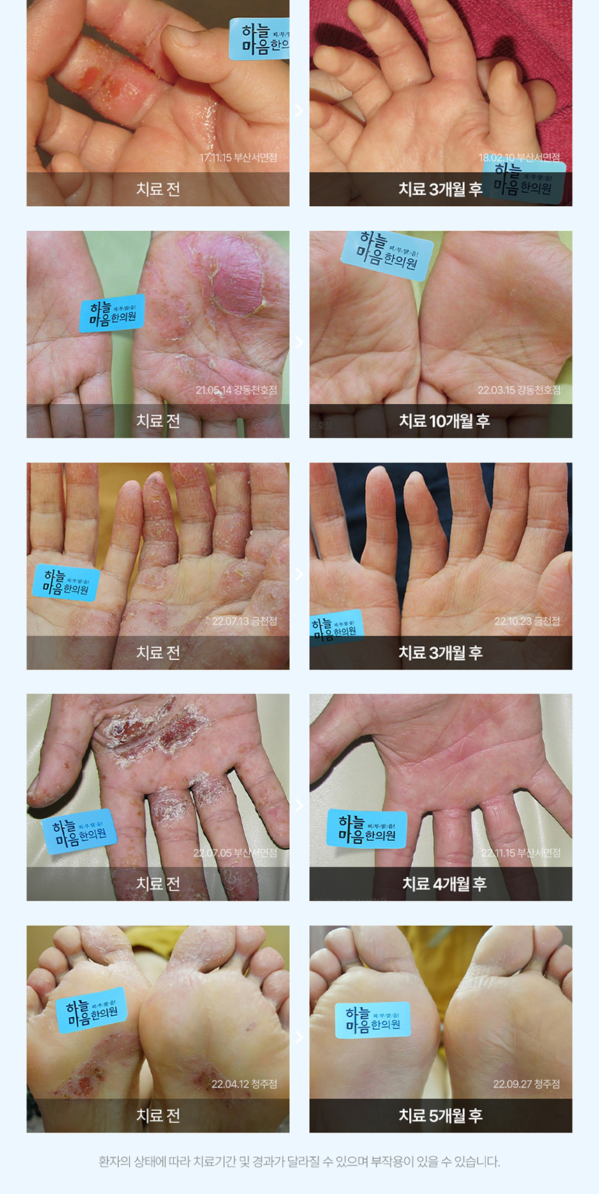 한포진 치료 전후 사례