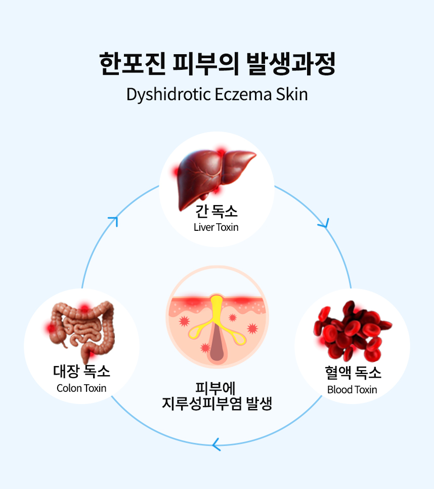 한포진 피부의 발생과정