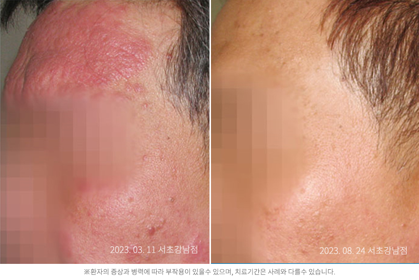 지루성피부염 병력 5년 50대 남자