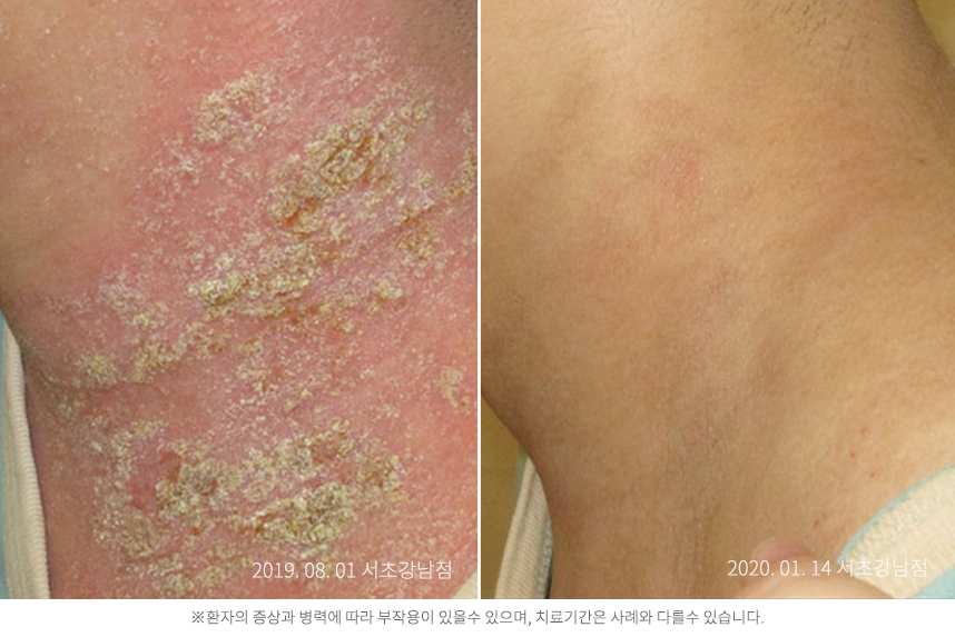 지루성피부염 병력 2년 20대 남자