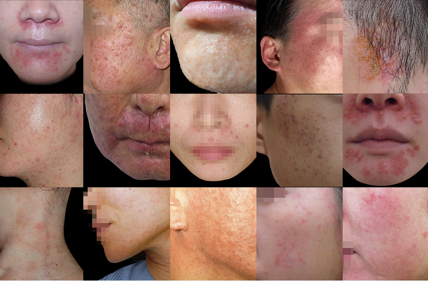 다양한 부위에 발병된 지루성피부염 사례들