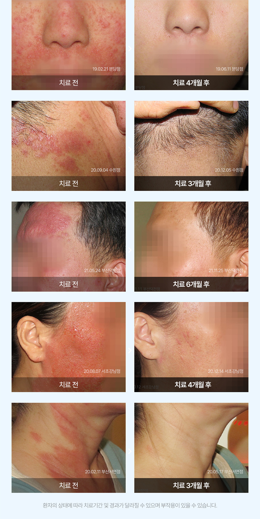 지루성피부염 치료 전후 사례