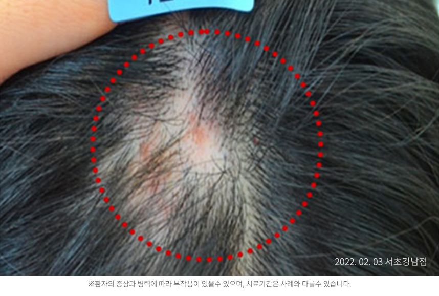 지루성두피염 병력 6개월 20대 남자