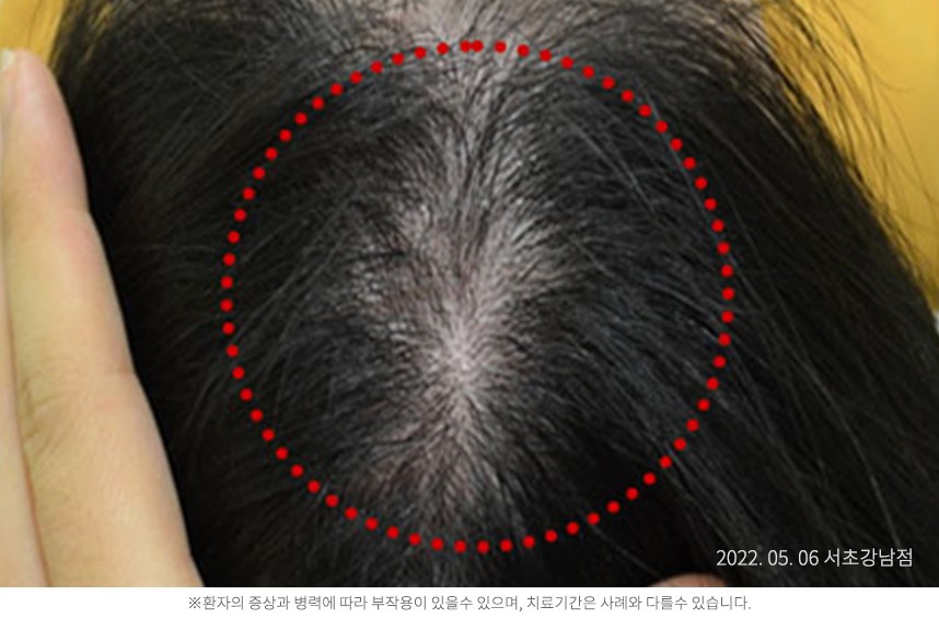 지루성두피염 병력 6개월 20대 남자