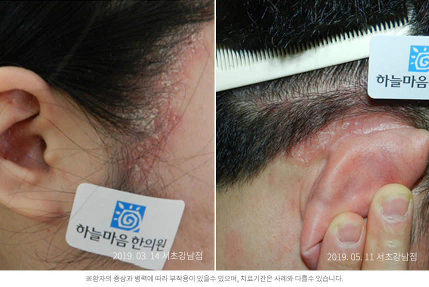 지루성두피염 케이스