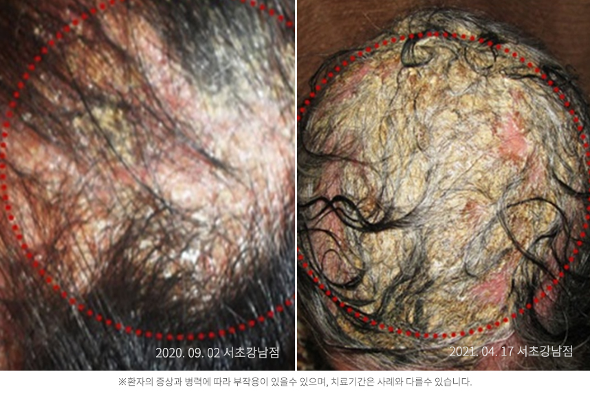 지루성두피염 케이스