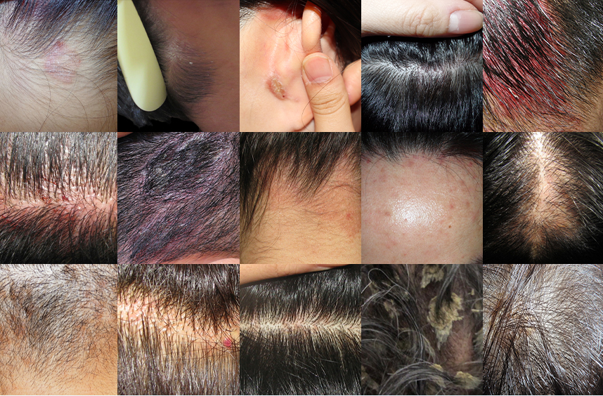 다양한 부위에 발병된 지루성두피염 사례들