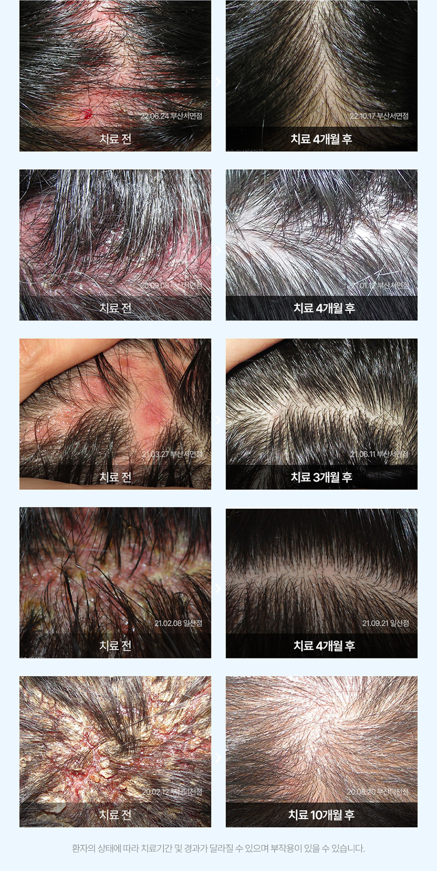 지루성두피염 치료 전후 사례