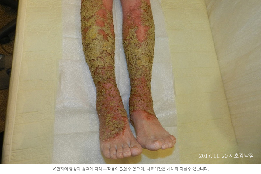 습진 병력 5년 30대 여자